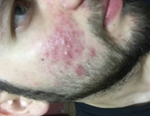 Acne With Redness 