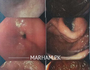 Sleep Problem And GERD