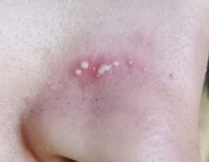 Pimple On Nose