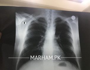Please Check Chest X-ray