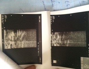 Regarding Lump In Breast 