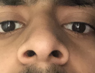 Fine Line Tear Trough