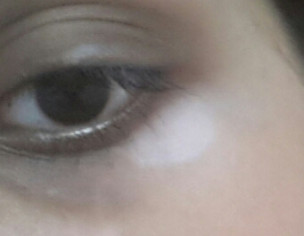 White Patch Under One Eye