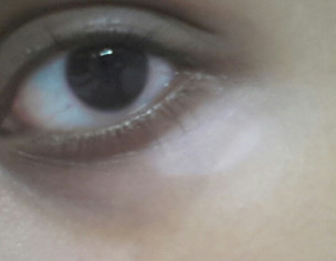 White Patch Under One Eye