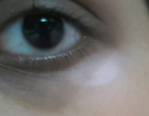 White Patch Under One Eye