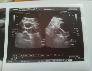 Gallbladder Stone Operation