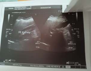 Gallbladder Stone Operation