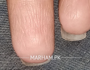 Fingerprints Are Getting Damaged