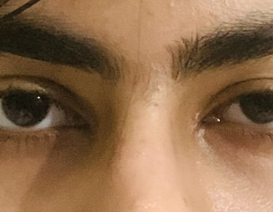 Ptosis Or Something