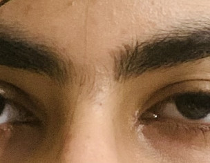 Ptosis Or Something
