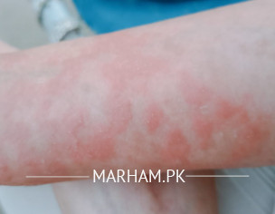 Skin Allergy Ya Dermatitis