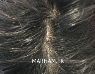 Androgenetic Alopecia Level 2