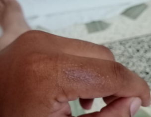 Skin Problem