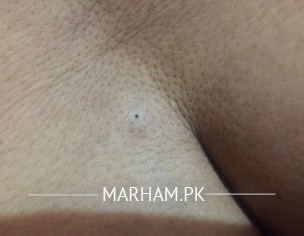 Blackhead Inside Pimple