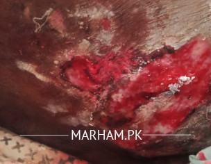 Diabetic With Injury