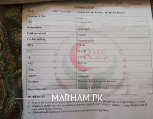 Bilateral Hydroneprosis