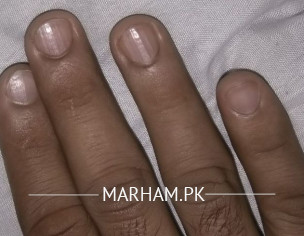 Lines In Nail