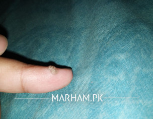 Wart Skin Problem
