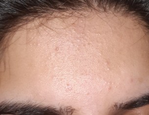 Pcos N Periods Issue