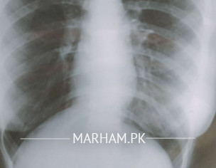 Chest Xray