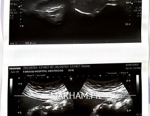 Stones In Gall Bladder