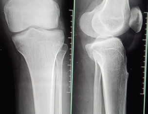 Knee Bone Dislocation