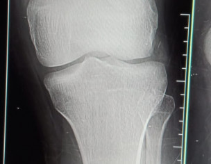 Knee Bone Dislocation