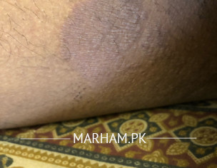 Dry Scaly Itchy Patch