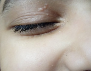Skin Tiny Bumps On Eye