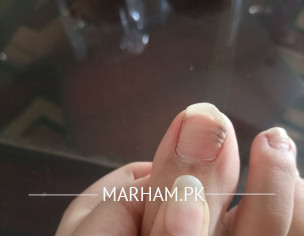 Horizontal Ridges In Nail