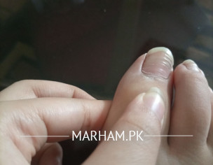 Horizontal Ridges In Nail