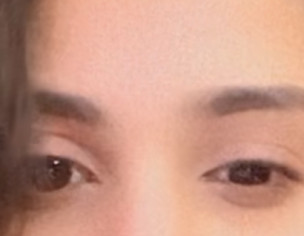 Difference In The Size If Eyes