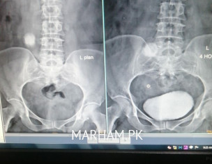 Kidny Stone And Swelling