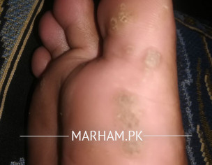 Foot Corn | Dermatologist