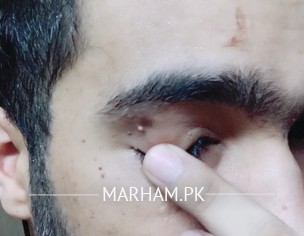 Injury Spots On Face