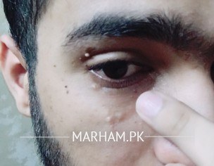 Injury Spots On Face