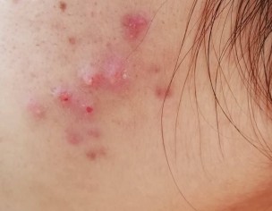 Acne (Pimples) 