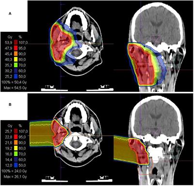 Advanced External Beam Radiation Methods, Frontiers | Intensity Modulated Radiotherapy (IMRT) With Carbon Ion Boost in the Multimodal ...