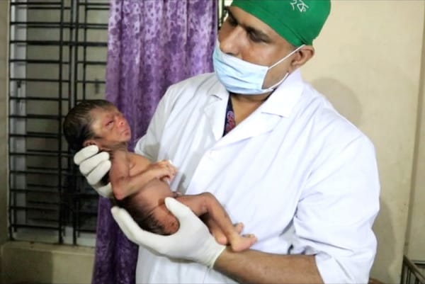 benjamin button baby 5 - Doctors Are SHOCKED When They See This Newborn Baby That Looks Like An 80-Year-Old Man!