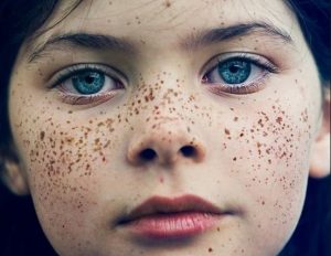 12 symptômes méconnus qui peuvent être un cancer how to get rid of freckles on face and lips fast permanently 300x232 - 12 symptômes méconnus qui peuvent être un cancer