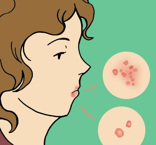 img 5a472d343c5f5 - 10 fatos que todos deveriam saber sobre a herpes labial