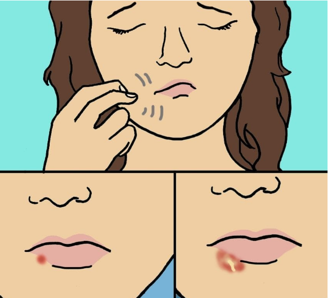 img 5a472d57278fc - 10 fatos que todos deveriam saber sobre a herpes labial