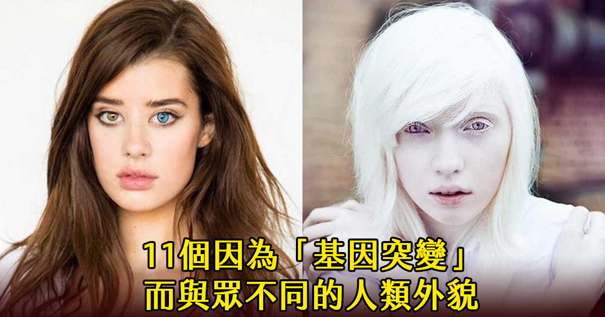 11个被票选为「最美的基因突变」的人类外貌