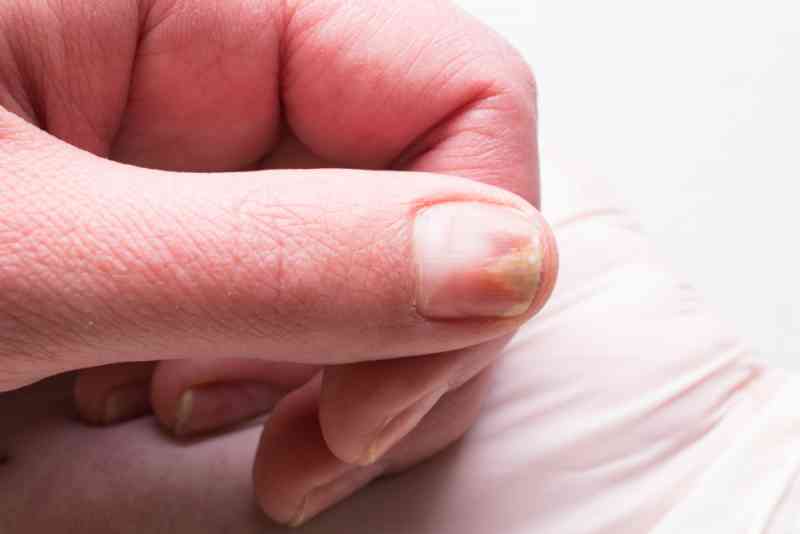 Fingernail Types And How They Might Indicate Something Is Wrong With ...