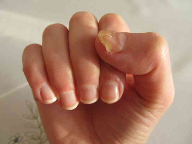 fingernail-types-and-how-they-might-indicate-something-is-wrong-with