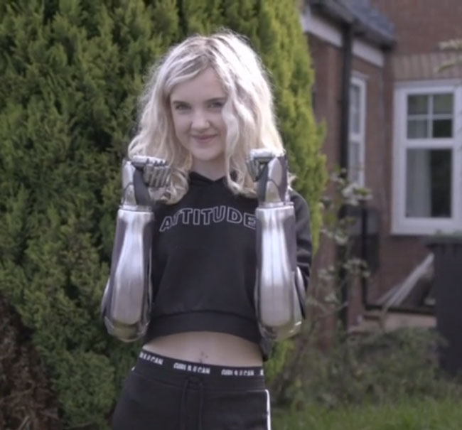 Girl Who Had Both Her Arms Amputated When She Was A Child Is