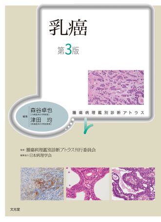 ファッションアイテムを 大腸癌 第2版[本/雑誌] (腫瘍病理鑑別診断