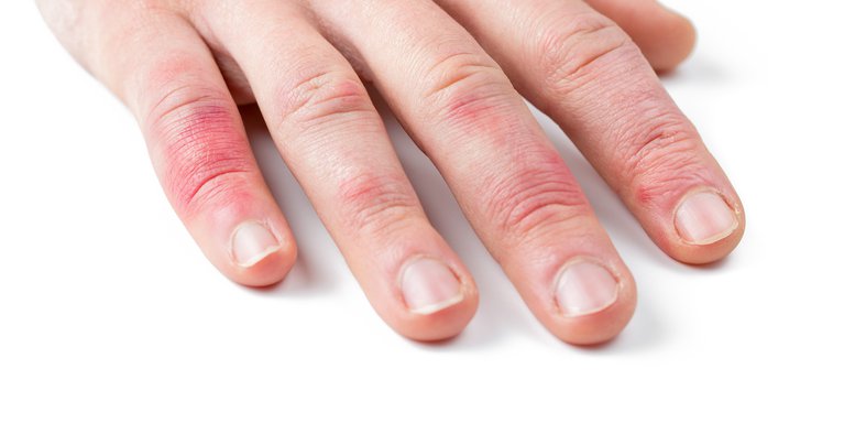 Qué es la Dermatitis en las manos? Consejos | Halibut