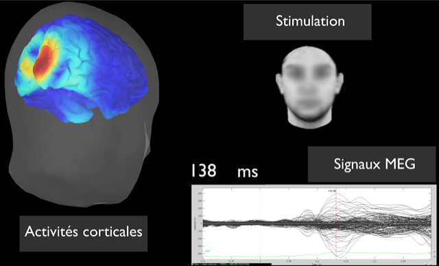 Affichage de l'écran : zones actives du cerveau (à gauche), stimulus visuel (visage) et signaux MEG en fonction du temps. ©Cermep