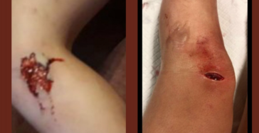 Noodzakeloperaties tumor